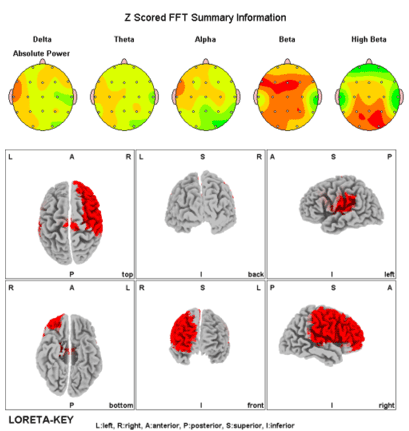 qEEG brain-mapping comparison used alongside neuropsychological assessment in Calgary